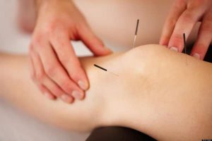 dry needling pros and cons